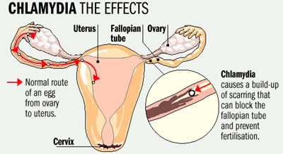 diagram-chlamydia-symptoms-in-women