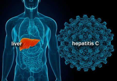 Hepatitis C Test in Fresno